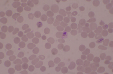 Malaria blood parasit infected red blood cells.