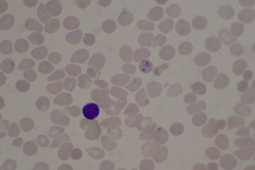 Malaria blood parasit infected red blood cells.