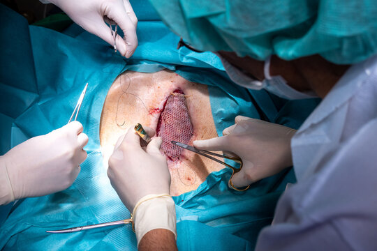 A Patient Has Split Skin Transplanted On The Abdomen To Cover A Wound