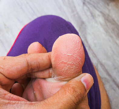 Closeup shot of cracked skin of great toe of foot. Pedicure concept image