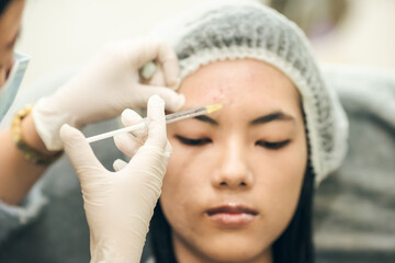 Closeup hand. Doctor injection for acne treatment on forehead. Add noise film grain.