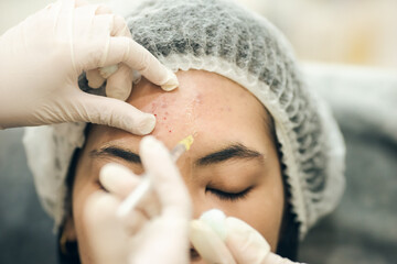 Closeup skin face. Doctor injection for acne treatment on forehead. Add noise film grain
