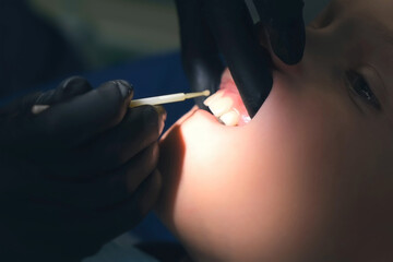 Doctor hygienist applying fluoride to teen teeth with cotton swab in dentistry. Covering using...