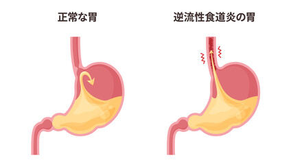 逆流性食道炎の胃と胃酸のイラスト
