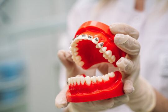 Hands in latex gloves hold an open dental jaw with braces, close-up
