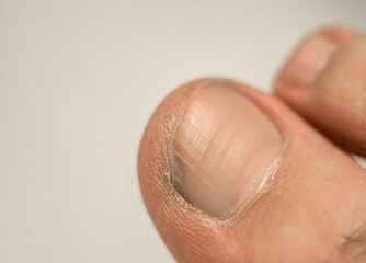 Nail fungus on the foot, the toes with problem nails