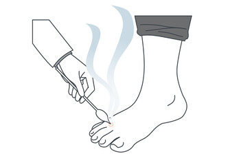 足にできたイボを液体窒素で治療するイラスト