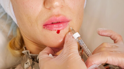 Professional cosmetic surgeon injects mature woman lips and blood appears during augmentation...