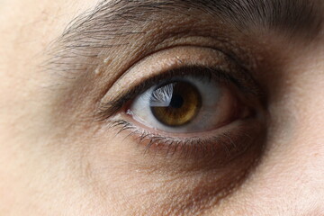 Macro brown male eye. The last stage of keratoconus. Critical stage of keratoconus. Eye disease