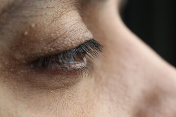 Macro brown male eye. The last stage of keratoconus. Critical stage of keratoconus. Eye disease