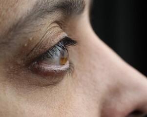 Macro brown male eye. The last stage of keratoconus. Critical stage of keratoconus. Eye disease