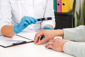 A dermatologist wearing gloves examines the skin of a sick patient. Examination and diagnosis of...