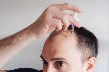 Hair loss treatment for men concept. Young caucasian man looking at mirror and applying anti-hair loss concentrate serum for regrow hair, close up. Baldness, alopecia in males.