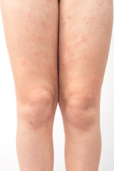 Acute atopic dermatitis on the feet of a child is a dermatological skin disease. Large, red, inflamed, scaly rash on the legs. Legs of a teenager with severe atopic eczema.
