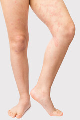 Acute atopic dermatitis on the feet of a child is a dermatological skin disease. Large, red,...