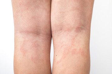 Acute atopic dermatitis on the legs behind the knees of a child is a dermatological disease of the skin. Large, red, inflamed, scaly rash on the legs. Legs of a teenager with severe atopic eczema