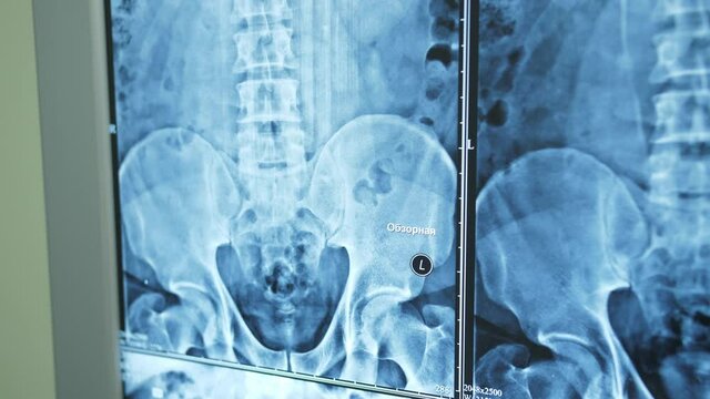 detailed close-up on X-rays of the spine and pelvis.