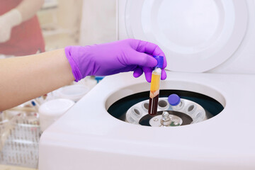Medical vial with blood plasma in hand for PRP extracted from the centrifuge machine