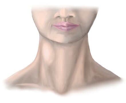 The carotid body tumor present wiht neck mass.