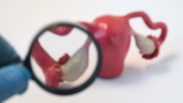 Diagnosis of female sexual reproductive system - ovaries, fallopian tubes causes of infertility. Doctor holding magnifying glass and through optical magnification diagnosed for diseases of ovaries