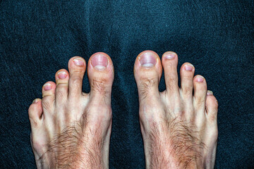 Men's feet with scuffs and calluses on the fingers. 