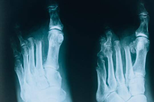 X-ray of two feet. Amputee fingers, bone and joint diseases