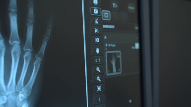 close-up of x-ray of hand on the monitor of medical equipment. panorama by buttons and icons of the computer interface.