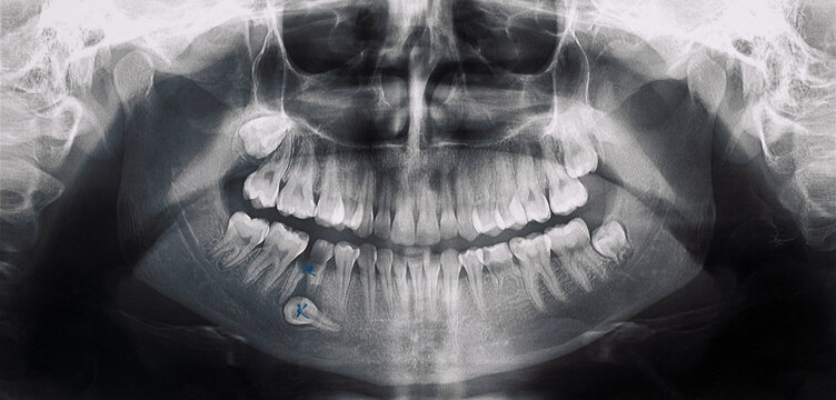 Panoramic black and white image dental x-ray of adult