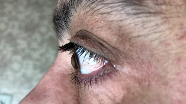 4K Macro brown male eye. End stage of keratoconus