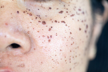 Fototapeta premium Backgrounds of lesions skin caused by acne on the face in the clinic. 