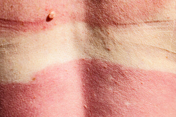 Fototapeta premium Woman back skin hurt from sun burn.