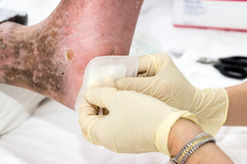 Nursing care for diabetics - diabetes care