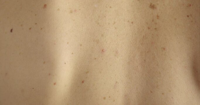 Close-up of large rashes or smallpox on the skin of an adult male. Pigmented spots on the back of a man. Skin of a man with moles. Acne. Problem skin. Skin care