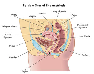 Medical illustration shows possible sites in the woman's body where endometriosisis could develop, with annotations.