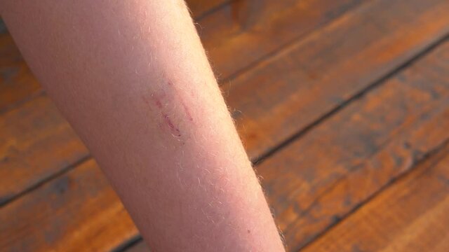 Closeup view 4k video of injured young kid's leg after he fell down on stairs. Boy inspecting his wounded scraped leg on summer day outdoors. Leg isolated on blurry brown wooden house deck background.