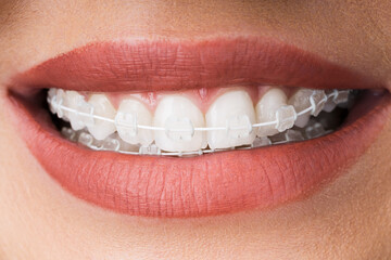 Female Mouth With Metal White Dental Braces
