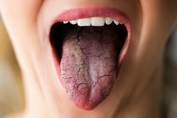 Woman Tongue With Bad Bacteria Candidiasis