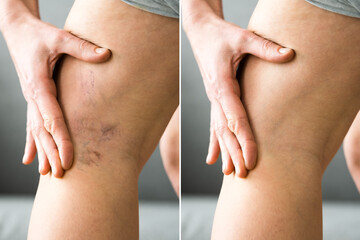 Before After Cellulite Inflammation Legs Treatment