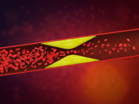 atherosclerosis with plaque in vessel