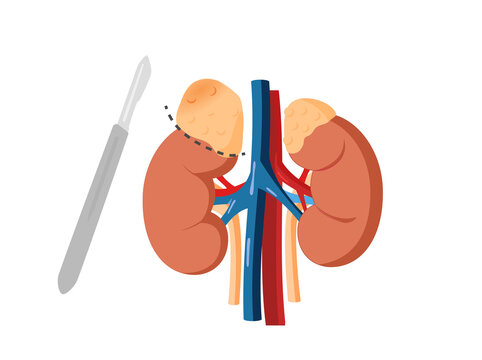 Adrenal adenoma removal. Cancer operation concept.