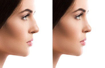 Comparison of female face after rhinoplasty