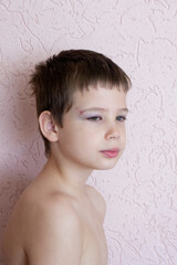 A child with an eye and eyelid injury. Bruise, hematoma in the boy