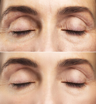Anti aging treatment. Female eyes after rejuvenation.
