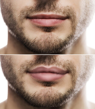 Lip augmentation. Male lips  before and after filler injection.