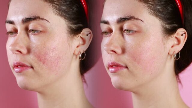 A face of a young caucasian woman in close-up showing the result before and after rosacea treatment. Split screen. The concept of couperose and rosacea.