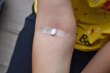 cotton placed with tape on arm pit after injection to restrict the blood flow