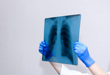 Hands of a doctor with an x-ray of the lungs, fluorography of the lungs, with a picture on a light background. Medical staff, medicine concept. Pneumonia.