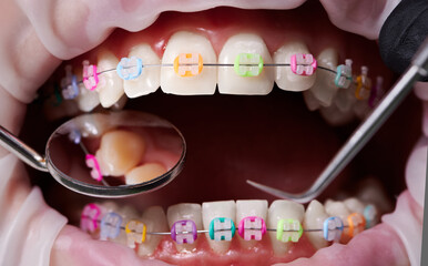 Macro snapshot of open mouth, teeth, ceramic braces with colorful rubber bands on them, latex cheek retractor on lips. Dentist checking teeth with mirror and dental explorer. Concept of orthodontics - obrazy, fototapety, plakaty