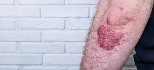 Psoriasis. Autoimmune genetic disease. A man with sore hands, dry flaky skin on his arm with psoriasis vulgaris, eczema. A large, red, inflamed, scaly rash on the elbows, a dermatological skin disorde - obrazy, fototapety, plakaty