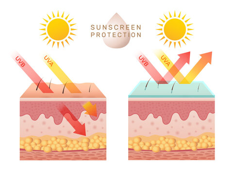 Uv Skin Protection. Damaged Human Skin Peels Before And After Sun Protection Body Adipose Layers Epidermis Recent Vector Infographic Template. Uv Sunburn, Ultraviolet To Body Damage Illustration